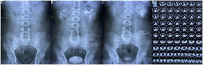 Case Report: A Calculus-Free Ureteral Stent Forgotten for 29 Years